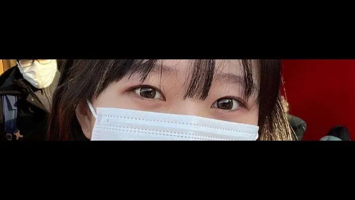 切开法（双眼皮） — RE&RE PLASTIC SURGERY 5