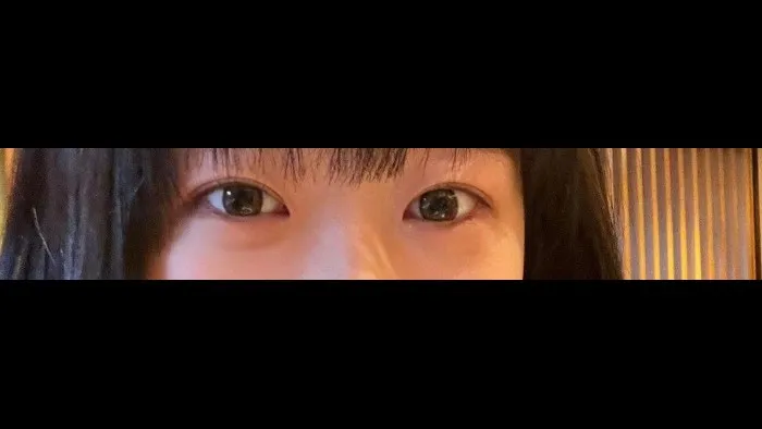 切开法（双眼皮） — RE&RE PLASTIC SURGERY 6