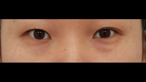 Incisional Double Eyelid Surgery, Ptosis Correction, Lower Eyelid Fat Repositioning, Lower Eyelid Fat Grafting 1