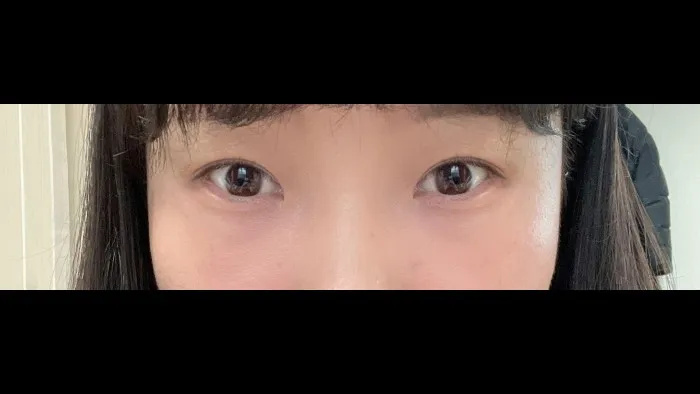 Incisional Double Eyelid Surgery, Ptosis Correction, Lower Eyelid Fat Repositioning, Lower Eyelid Fat Grafting 2