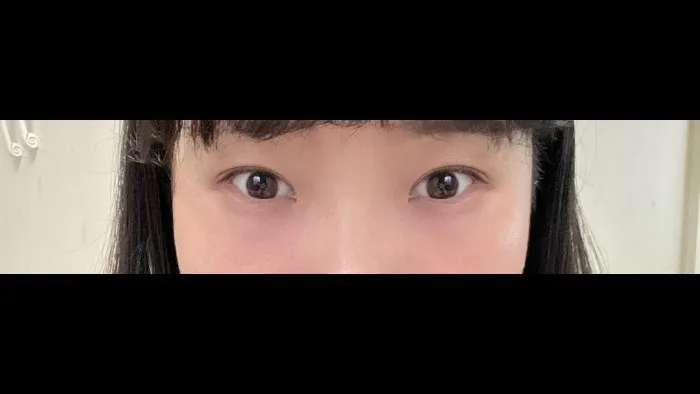 切开法（双眼皮）, 眼型矫正术, 眼底脂肪重排, 眼底脂肪填充 — RE&RE PLASTIC SURGERY 3