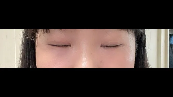 切开法（双眼皮）, 眼型矫正术, 眼底脂肪重排, 眼底脂肪填充 — RE&RE PLASTIC SURGERY 4