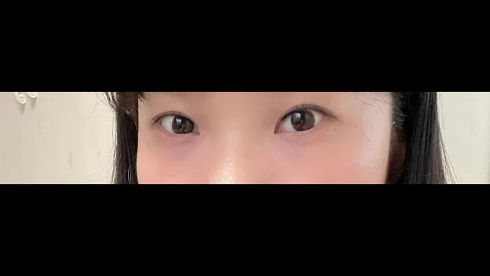 切开法（双眼皮）, 眼型矫正术, 眼底脂肪重排, 眼底脂肪填充 — RE&RE PLASTIC SURGERY 5