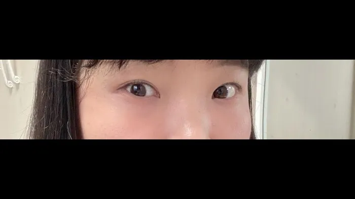 切开法（双眼皮）, 眼型矫正术, 眼底脂肪重排, 眼底脂肪填充 — RE&RE PLASTIC SURGERY 6