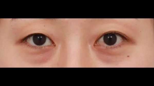 自然癒着法, 目つき矯正, 目の下脂肪再配置 — RE&RE PLASTIC SURGERY 1