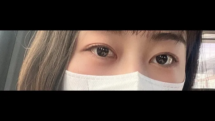 自然癒着法, 目つき矯正, 目の下脂肪再配置 — RE&RE PLASTIC SURGERY 2