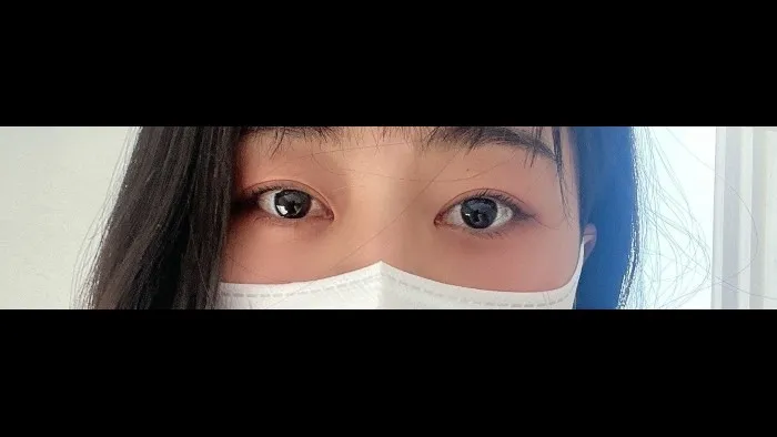 自然癒着法, 目つき矯正, 目の下脂肪再配置 — RE&RE PLASTIC SURGERY 3