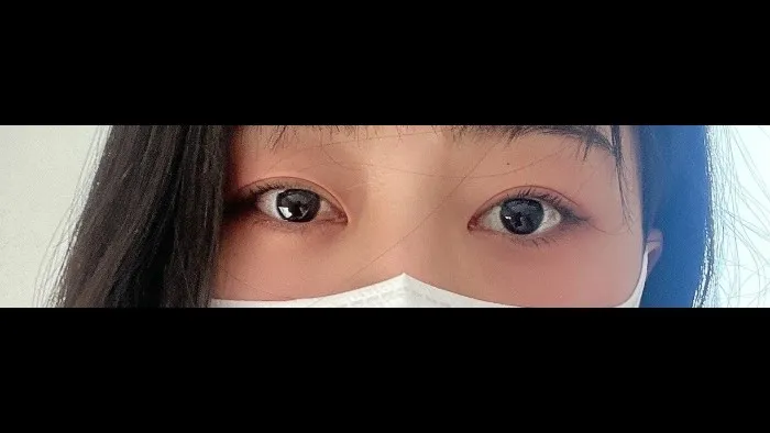自然癒着法, 目つき矯正, 目の下脂肪再配置 — RE&RE PLASTIC SURGERY 4