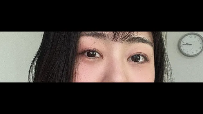 自然癒着法, 目つき矯正, 目の下脂肪再配置 — RE&RE PLASTIC SURGERY 5