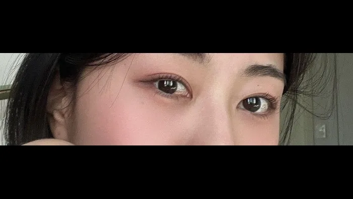 自然癒着法, 目つき矯正, 目の下脂肪再配置 — RE&RE PLASTIC SURGERY 6