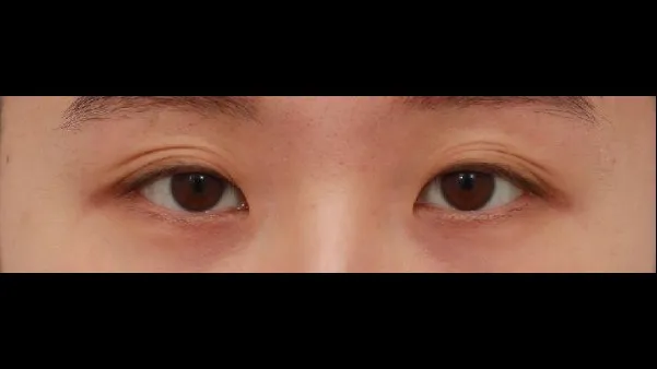 Partial Incision Double Eyelid Surgery, Ptosis Correction 1