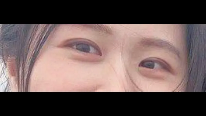 Partial Incision Double Eyelid Surgery, Ptosis Correction 2