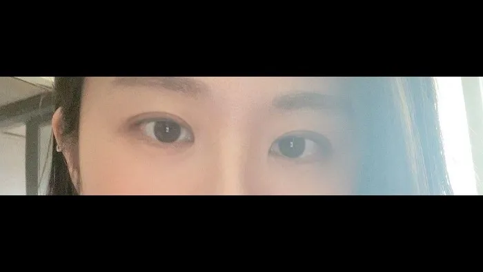 双眼皮部分切开术, 眼型矫正术 — RE&RE PLASTIC SURGERY 3