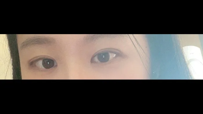 双眼皮部分切开术, 眼型矫正术 — RE&RE PLASTIC SURGERY 4
