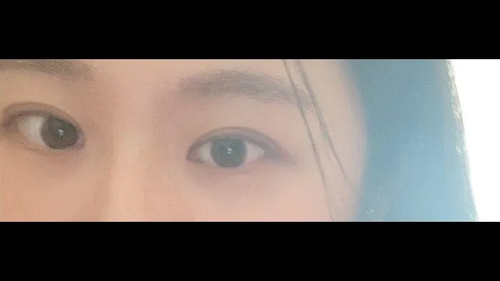 双眼皮部分切开术, 眼型矫正术 — RE&RE PLASTIC SURGERY 5