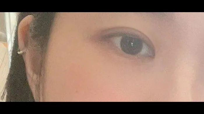 双眼皮部分切开术, 眼型矫正术 — RE&RE PLASTIC SURGERY 6