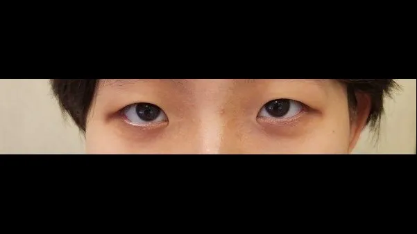Incisional Double Eyelid Surgery, Ptosis Correction — RE&RE PLASTIC SURGERY 1