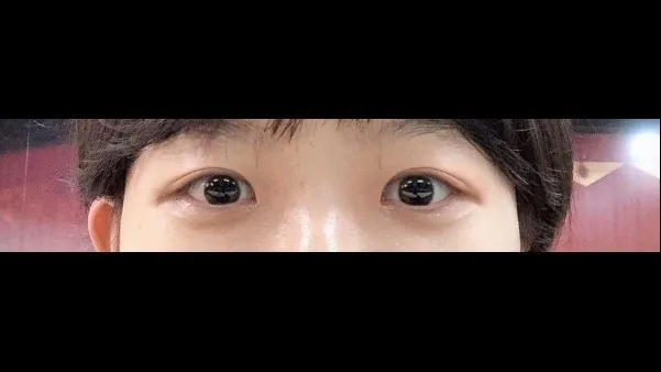 Incisional Double Eyelid Surgery, Ptosis Correction — RE&RE PLASTIC SURGERY 2