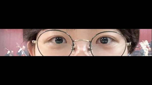 Incisional Double Eyelid Surgery, Ptosis Correction — RE&RE PLASTIC SURGERY 3