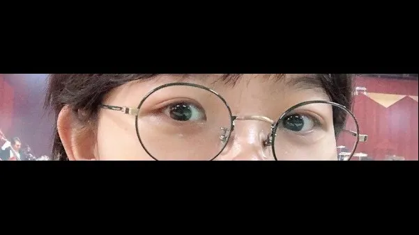 Incisional Double Eyelid Surgery, Ptosis Correction — RE&RE PLASTIC SURGERY 4
