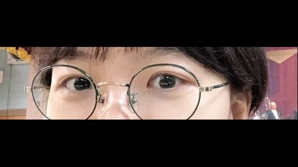Incisional Double Eyelid Surgery, Ptosis Correction — RE&RE PLASTIC SURGERY 5