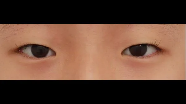 Natural Adhesion Double Eyelid Surgery, Ptosis Correction 1