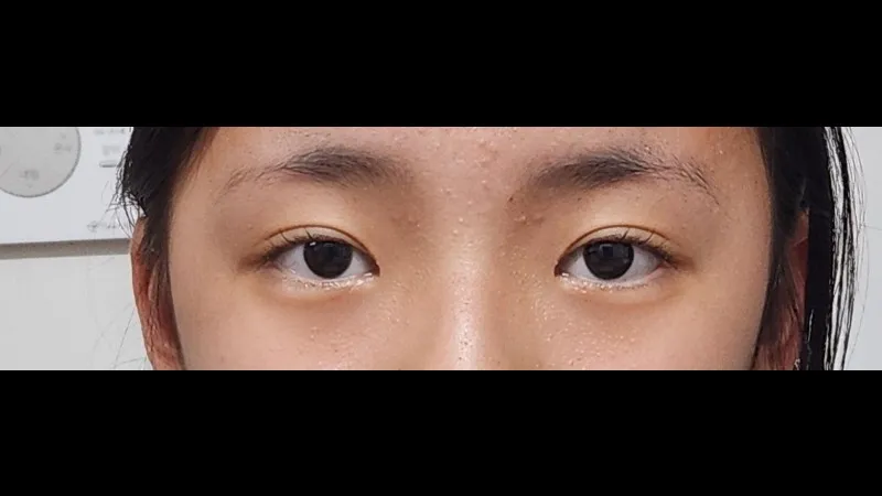 Natural Adhesion Double Eyelid Surgery, Ptosis Correction 2