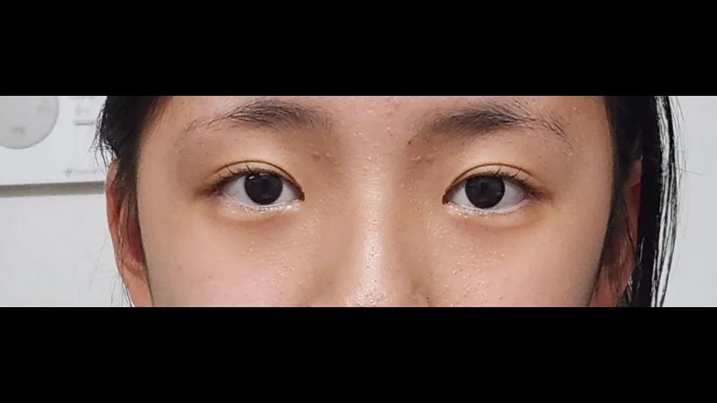 自然癒着法, 目つき矯正 — RE&RE PLASTIC SURGERY 3