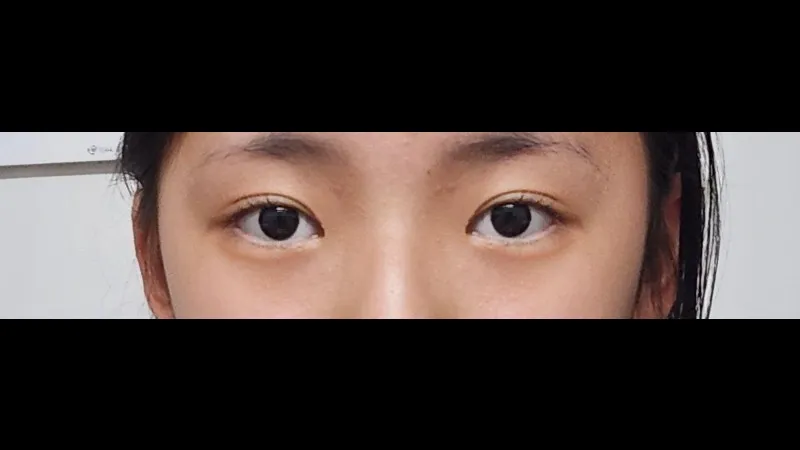 自然癒着法, 目つき矯正 — RE&RE PLASTIC SURGERY 4