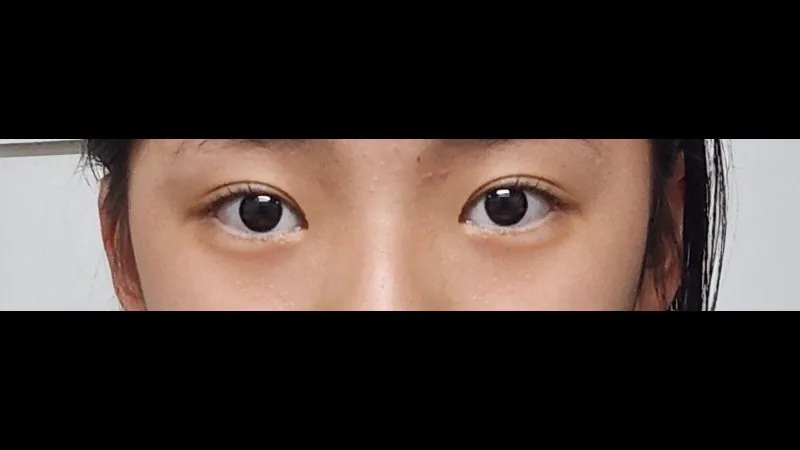 自然癒着法, 目つき矯正 — RE&RE PLASTIC SURGERY 5