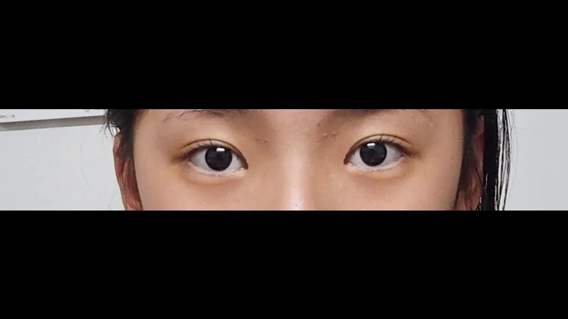 自然癒着法, 目つき矯正 — RE&RE PLASTIC SURGERY 6