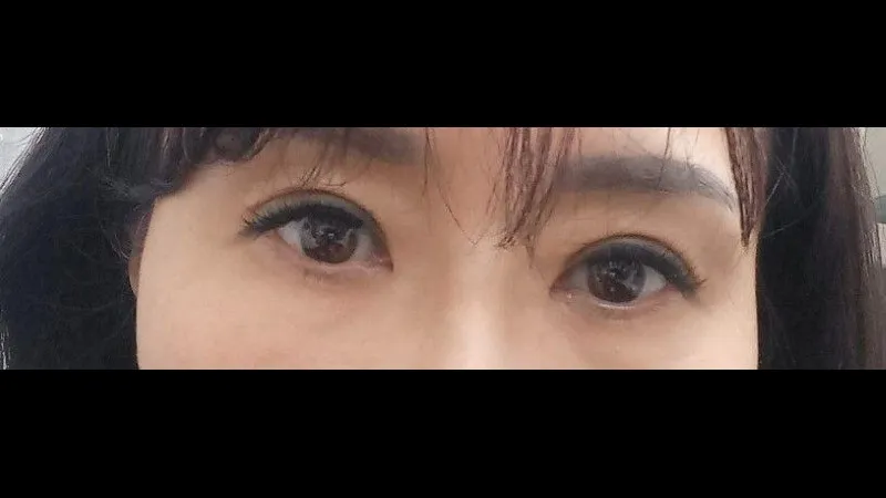 Sub-brow Lift — RE&RE PLASTIC SURGERY 3