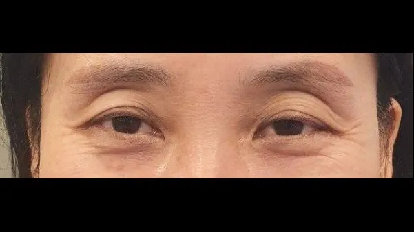 Sub-brow Lift, Lower Blepharoplasty (Aging Eye Rejuvenation), Lower Eyelid Fat Grafting, Midface Lift 1