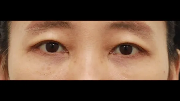 Sub-brow Lift, Lower Blepharoplasty (Aging Eye Rejuvenation), Lower Eyelid Fat Grafting, Midface Lift 2