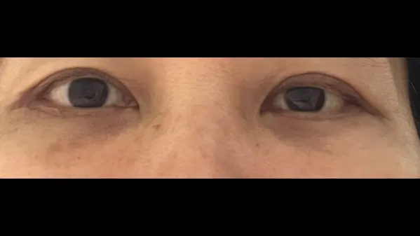 Sub-brow Lift, Lower Blepharoplasty (Aging Eye Rejuvenation), Lower Eyelid Fat Grafting, Midface Lift — RE&RE PLASTIC SURGERY 3
