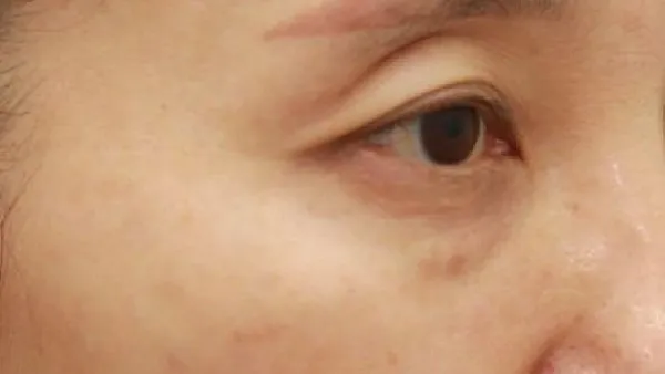 Sub-brow Lift, Lower Blepharoplasty (Aging Eye Rejuvenation), Lower Eyelid Fat Grafting, Midface Lift — RE&RE PLASTIC SURGERY 4