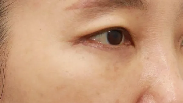 Sub-brow Lift, Lower Blepharoplasty (Aging Eye Rejuvenation), Lower Eyelid Fat Grafting, Midface Lift — RE&RE PLASTIC SURGERY 5
