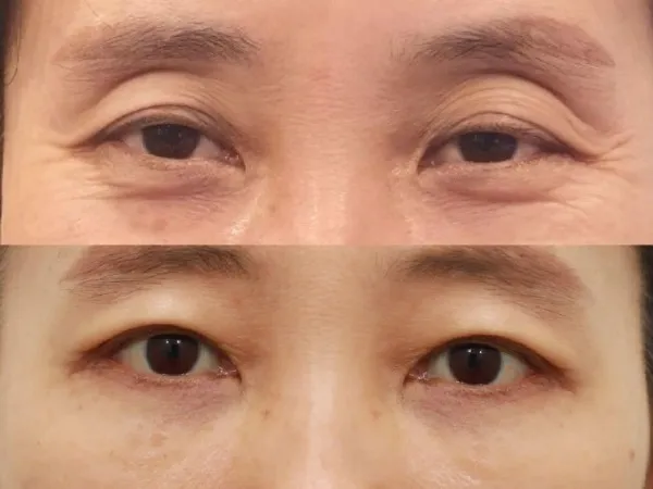 Sub-brow Lift, Lower Blepharoplasty (Aging Eye Rejuvenation), Lower Eyelid Fat Grafting, Midface Lift — RE&RE PLASTIC SURGERY 6