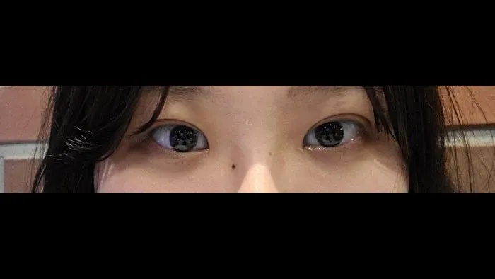 Incisional Double Eyelid Surgery — RE&RE PLASTIC SURGERY 2