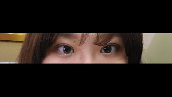 Incisional Double Eyelid Surgery — RE&RE PLASTIC SURGERY 3