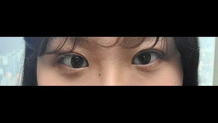 Incisional Double Eyelid Surgery — RE&RE PLASTIC SURGERY 4