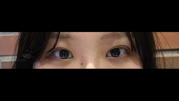 Incisional Double Eyelid Surgery — RE&RE PLASTIC SURGERY 5