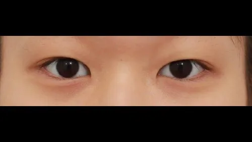 Incisional Double Eyelid Surgery — RE&RE PLASTIC SURGERY 1