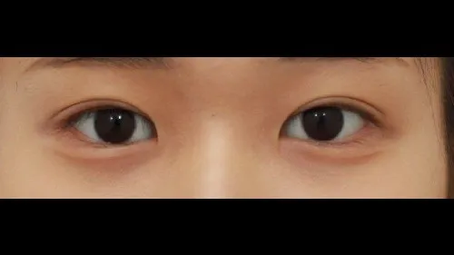 Incisional Double Eyelid Surgery — RE&RE PLASTIC SURGERY 2
