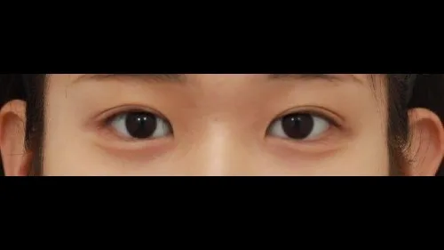 Incisional Double Eyelid Surgery — RE&RE PLASTIC SURGERY 3