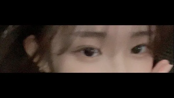 Incisional Double Eyelid Surgery — RE&RE PLASTIC SURGERY 5