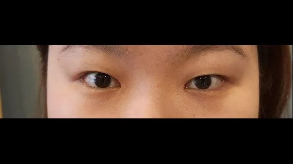Incisional Double Eyelid Surgery, Ptosis Correction, Nasal Tip, Nasal Bridge 1