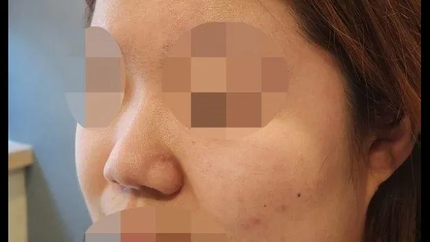 Incisional Double Eyelid Surgery, Ptosis Correction, Nasal Tip, Nasal Bridge 2
