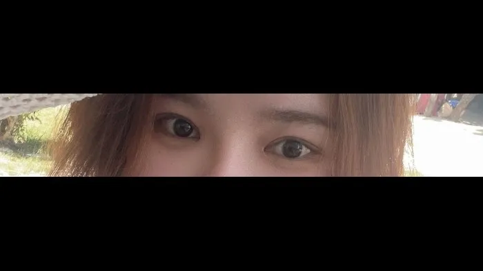 Incisional Double Eyelid Surgery, Ptosis Correction, Nasal Tip, Nasal Bridge — RE&RE PLASTIC SURGERY 4