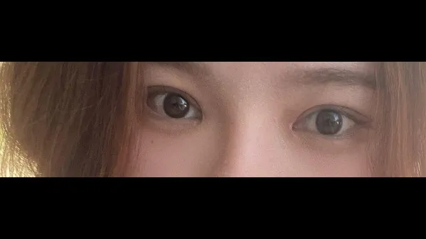Incisional Double Eyelid Surgery, Ptosis Correction, Nasal Tip, Nasal Bridge — RE&RE PLASTIC SURGERY 5